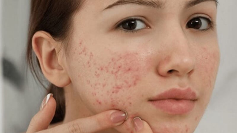 Tắm nước nóng có thể làm trầm trọng thêm tình trạng mụn trứng cá