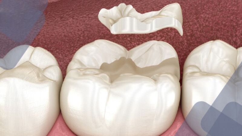 Trám sứ có chi phí cao Trám sứ có chi phí cao