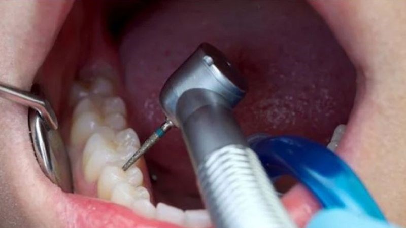 Dùng mũi hoan để loại bỏ phần răng không còn chức năng Dùng mũi khoan để loại bỏ phần răng không còn chức năng