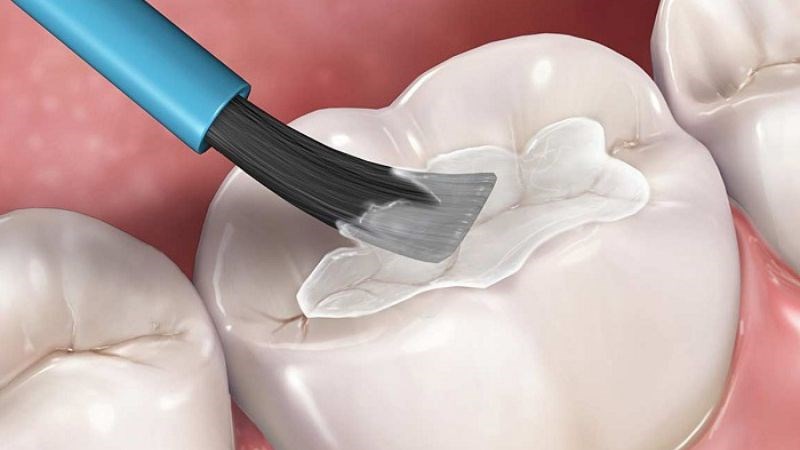 Dùng chất kết dính để đảm bảo miếng trám gắn chắc vào răng Dùng chất kết dính để đảm bảo miếng trám gắn chắc vào răng