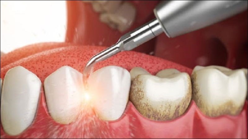 Đánh bóng răng để tạo nên màu tự nhiên nhất cho miếng trám Đánh bóng răng để tạo nên màu tự nhiên nhất cho miếng trám