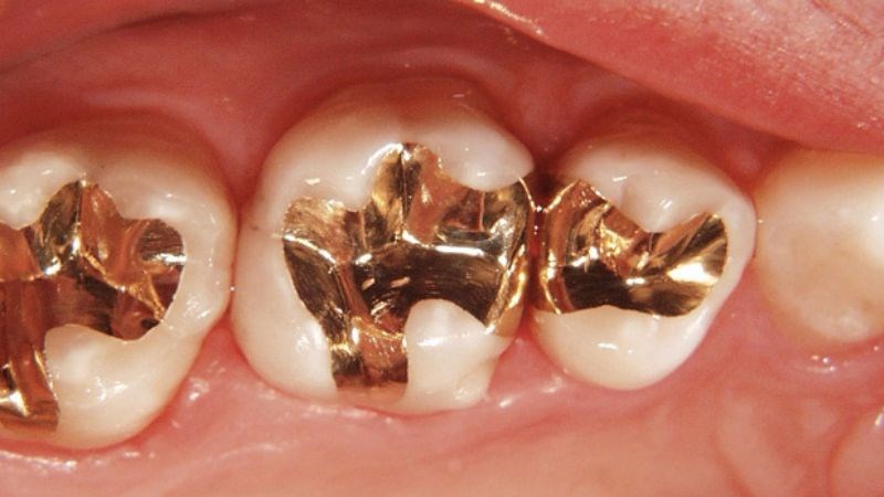 Trám vàng có chi phí khá là đắt đỏ Trám vàng có chi phí khá là đắt đỏ