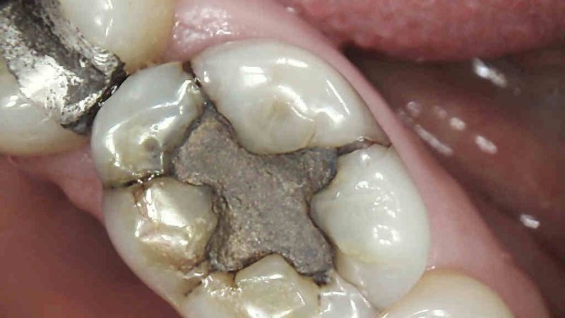 Trám bạc có độ bền dài hơn và rẻ hơn so với composite Trám bạc có độ bền dài hơn và rẻ hơn so với composite