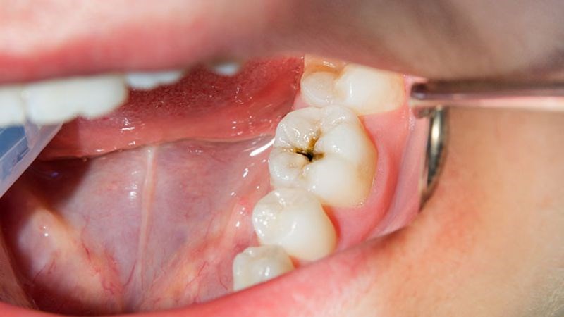 Đa phần mọi người sẽ không thấy đau trong khi trám răng Đa phần mọi người sẽ không thấy đau trong khi trám răng