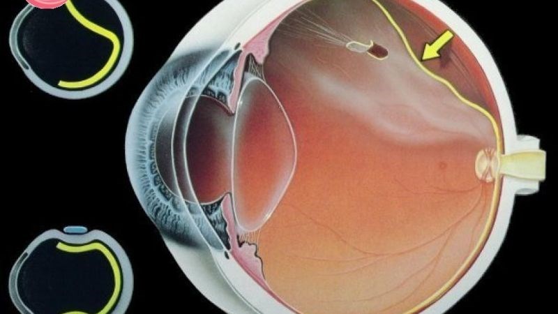 Nguy cơ phát triển bệnh bong võng mạc cao gấp 5 đến 6 lần ở những người cận thị nặng