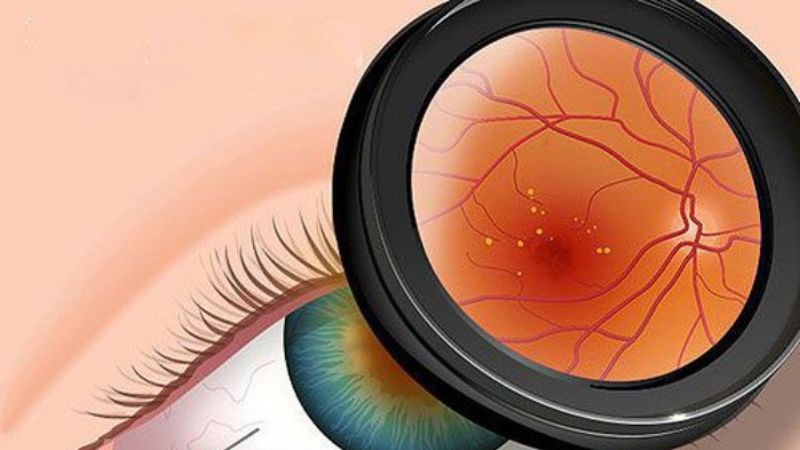 Cận thị nặng làm tăng nguy cơ thoái hóa điểm vàng ở người cao tuổi