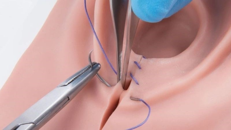 Nếu bị đau do cắt tầng sinh môn hoặc do bệnh trĩ sau sinh cũng có thể dẫn đến táo bón.