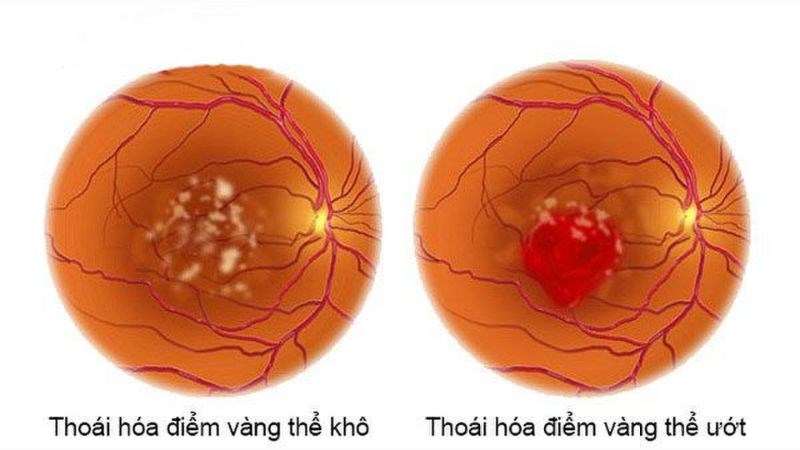 Tiếp xúc với ánh sáng xanh có thể gây thoái hoá điểm vàng