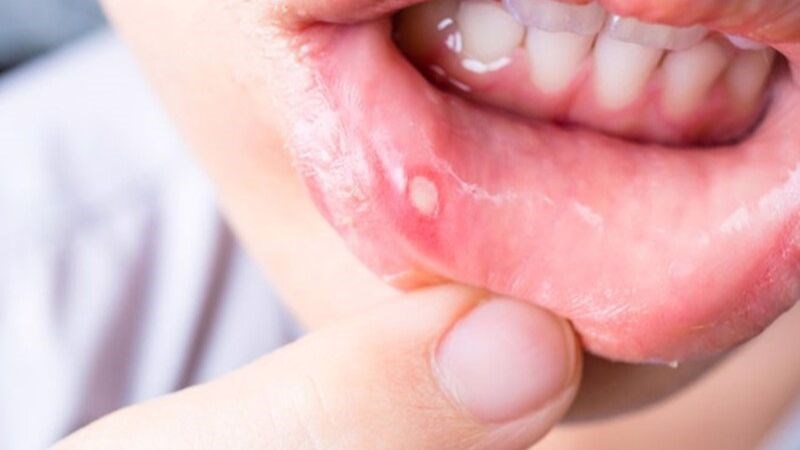 Súc miệng bằng nước muối có thể làm lành vết loét miệng