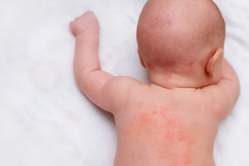 Trẻ nổi mề đay sau khi tiêm phòng là dấu hiệu cần đưa đến bác sĩ