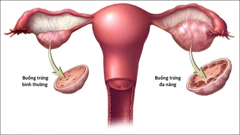 Những người mắc hội chứng buồng trứng đa nang có thể bị trễ kinh