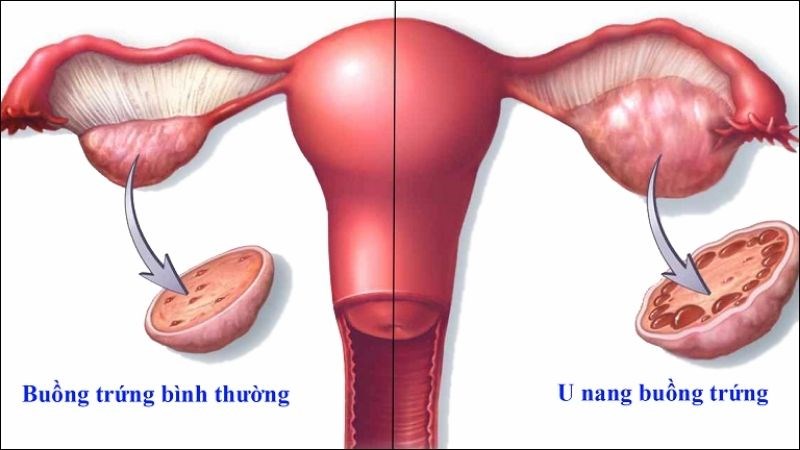 U nang buồng trứng ảnh hưởng đến quá trình rụng trứng và chu kỳ kinh nguyệt