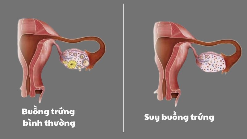 Suy buồng trứng nguyên phát khiến cơ thể không tạo đủ lượng hormon bình thường