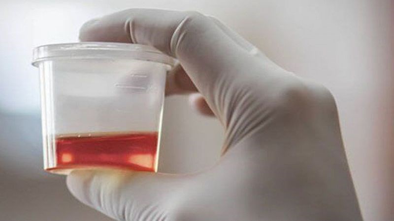 Khi có máu trong nước tiểu cần đi gặp bác sĩ