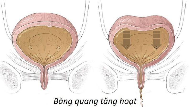 Rối loạn chức năng bàng quang là nguyên nhân tiểu đêm