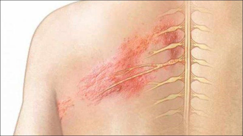 VZV gây bệnh zona thần kinh