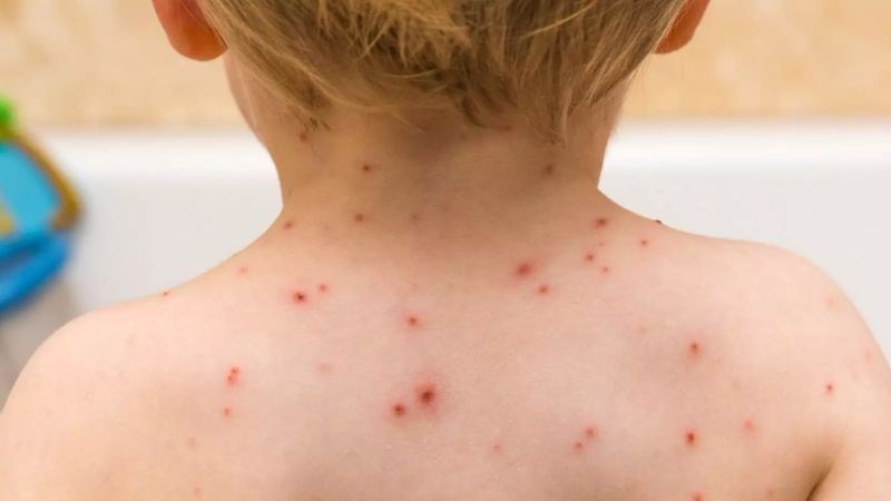 Bọng nước sau khi vỡ để lại vảy màu nâu mật ong, bong đi không để lại sẹo