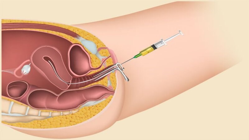 Điều trị vô sinh nam giới bằng phương pháp thụ tinh nhân tạo