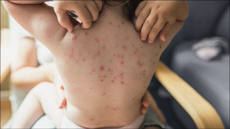 Giai đoạn toàn phát triệu chứng biểu hiện rầm rộ