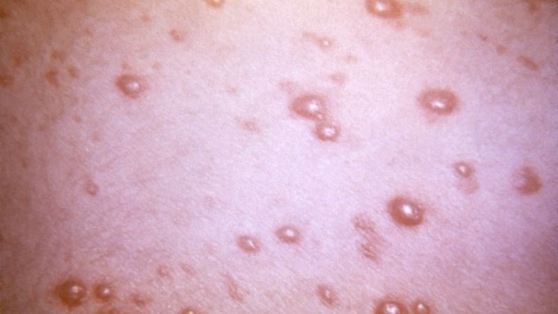 Dịch bọng nước vỡ ra gây phát tán virus ra xung quanh