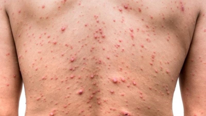 Bệnh lây lan mạnh nhất ở giai đoạn toàn phát