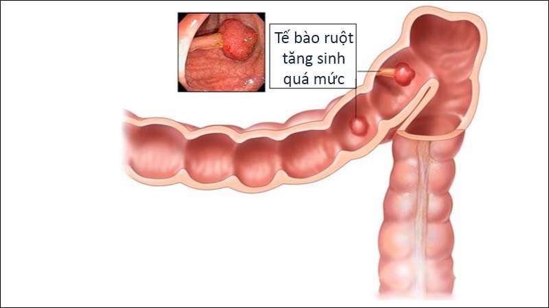 Tế bào trong ruột thừa tăng sinh quá mức.