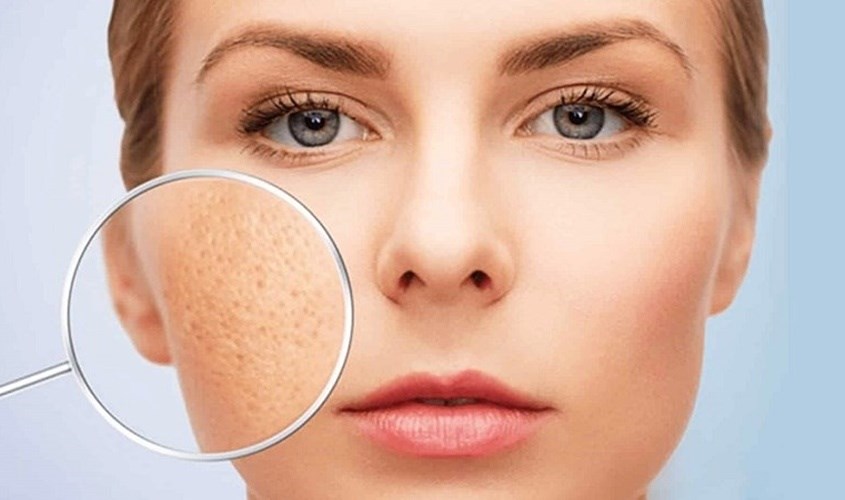 Sự thay đổi của da hỗn hợp vào mùa hè