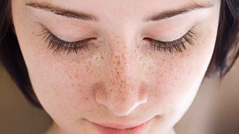 Tàn nhang không thể loại bỏ hoàn toàn, chỉ có thể làm mờ 