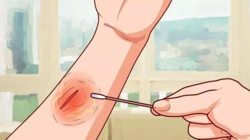 Rửa vết thương để tránh tình trạng nhiễm khuẩn