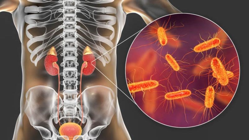 Viêm thận là một trong những nguyên nhân gây nên nhiễm khuẩn huyết
