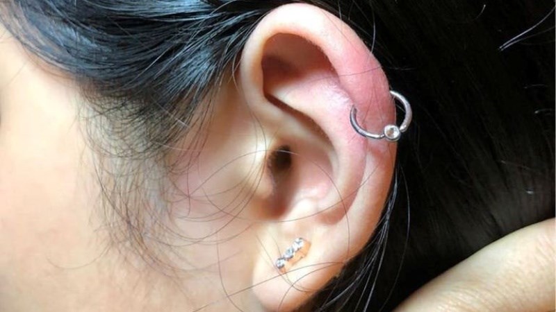 Sưng sụn vành tai do xỏ khuyên gây ra Sưng sụn vành tai do xỏ khuyên gây ra
