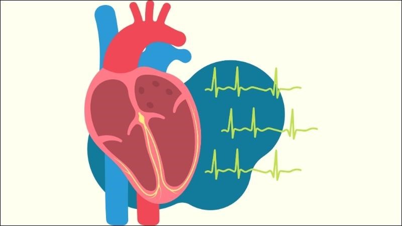 Nhịp nhanh thất là một loại rối loạn nhịp tim