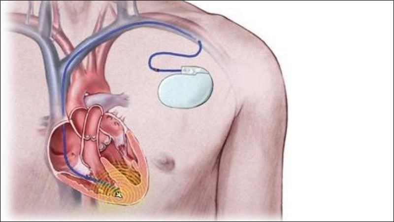 Cấy máy ICD có thể được áp dụng để điều trị nhịp nhanh thất