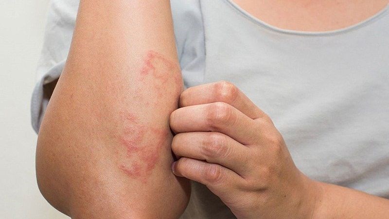 Ăn nhiều đậu phộng có thể bị dị ứng