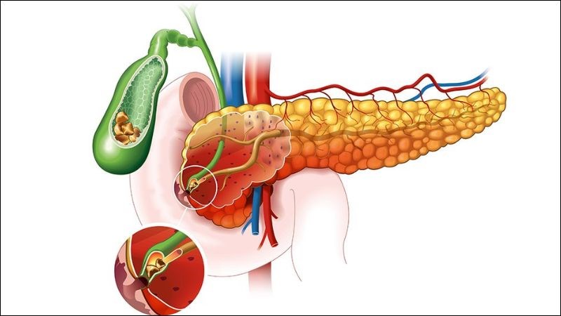 Đậu phộng có tác dụng giảm hàm lượng cholesterol, ngăn ngừa sỏi mật 