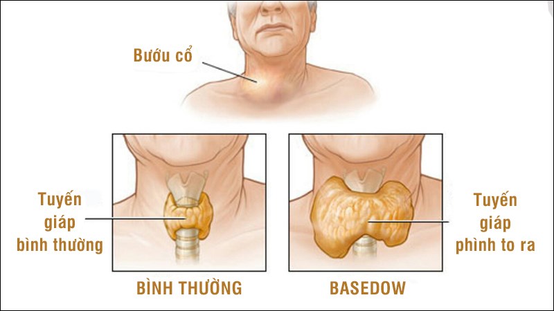 Basedow (hay Graves) đều là tên gọi khác của bệnh cường giáp