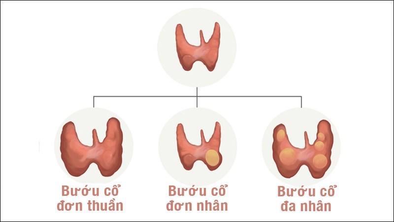 Phân loại bướu cổ dựa trên hình thái 
