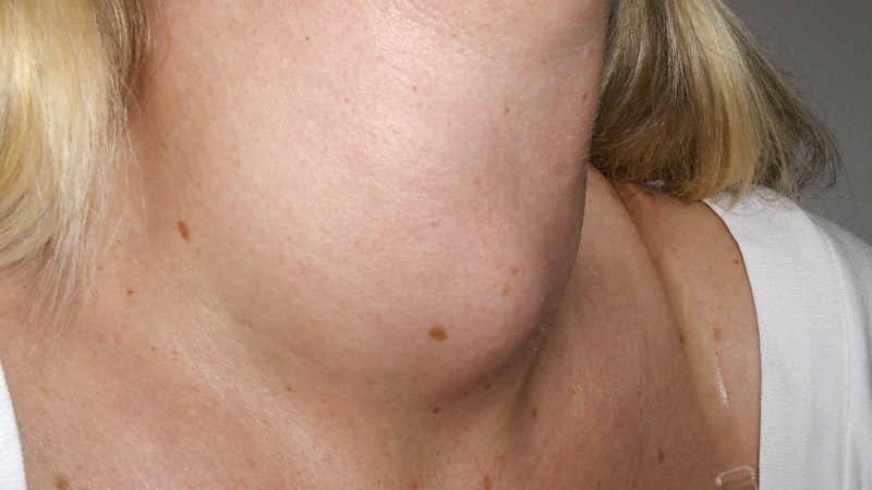 Dấu hiệu chính của bướu cổ là sưng phần trước cổ, thường không đau