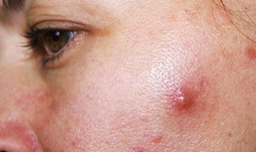 lượng dầu trên da tăng lên khi các tuyến bã nhờn sản xuất quá nhiều dầu