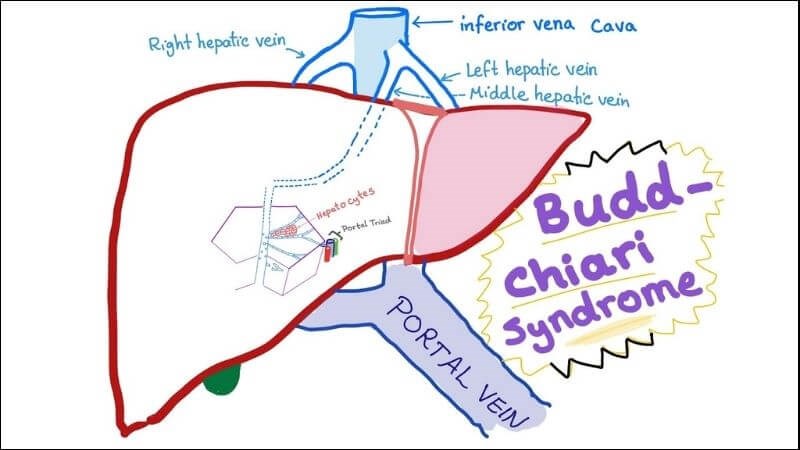 Hội chứng Budd Chiari
