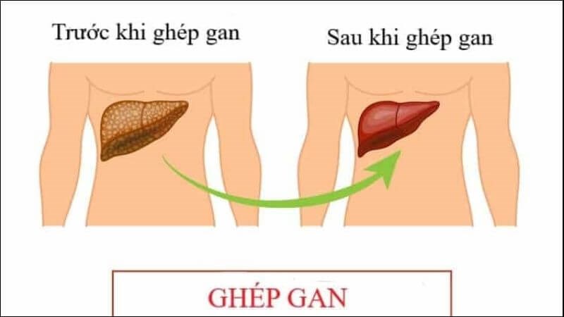 Ghép gan khi cần thiết