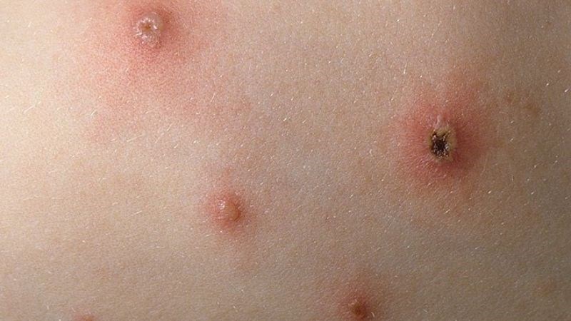 Kích thước tổn thương Kích thước tổn thương