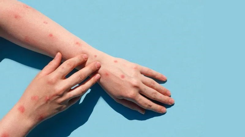 Bệnh đậu mùa khỉ là bệnh truyền nhiễm do virus gây ra Bệnh đậu mùa khỉ là bệnh truyền nhiễm do virus gây ra