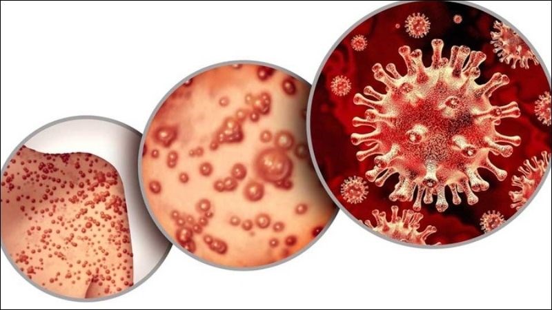 Thời gian ủ bệnh Thời gian ủ bệnh kéo dài từ 7 đến 14 ngày