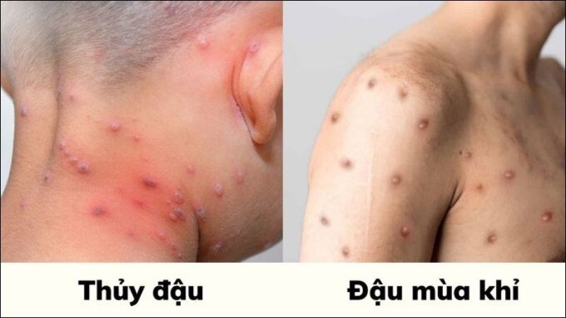 Điểm giống nhau giữa đậu mùa khỉ và thủy đậu Cả hai bệnh đều có các diễn tiến tổn thương da giống nhau