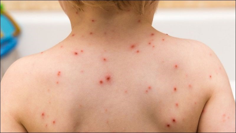Bệnh thủy đậu Bệnh thủy đậu