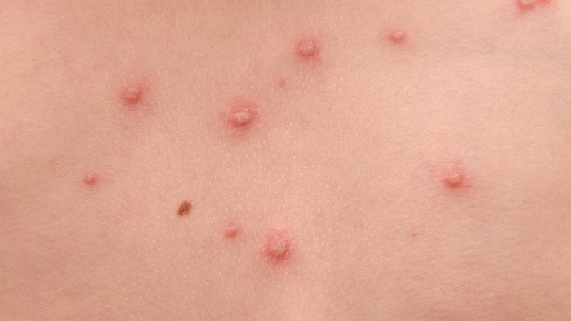 Mụn nước Mụn nước