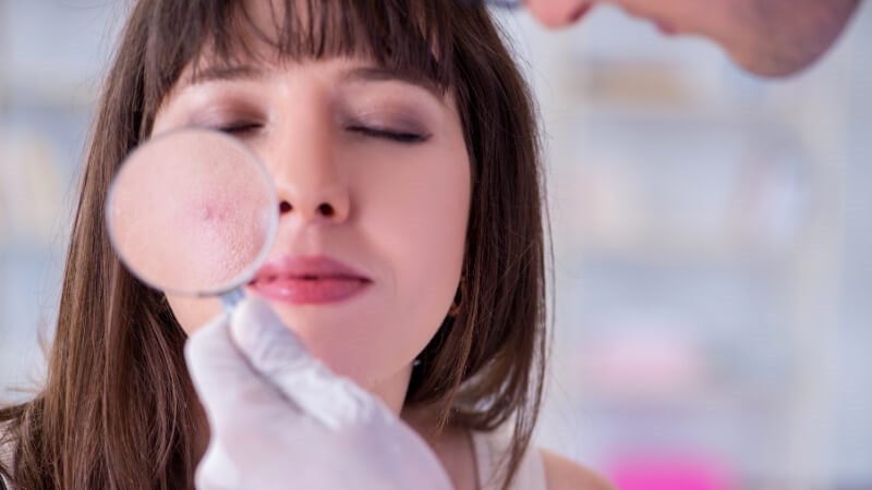Không cần thiết phải xét nghiệm khi chẩn đoán mụn trứng cá