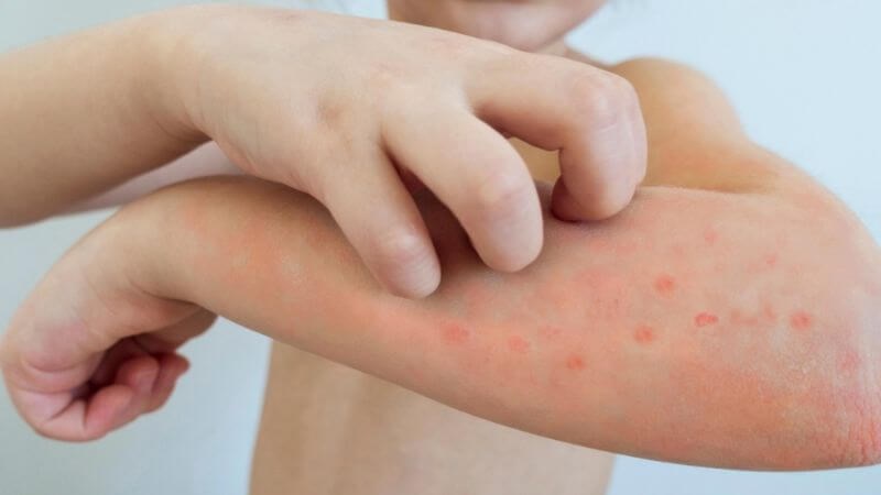 Hạn chế gãi mụn nước để tránh làm nặng bệnh