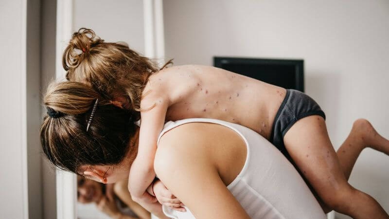 Bệnh thủy đậu lây qua dịch tiết hoặc tiếp xúc trực tiếp